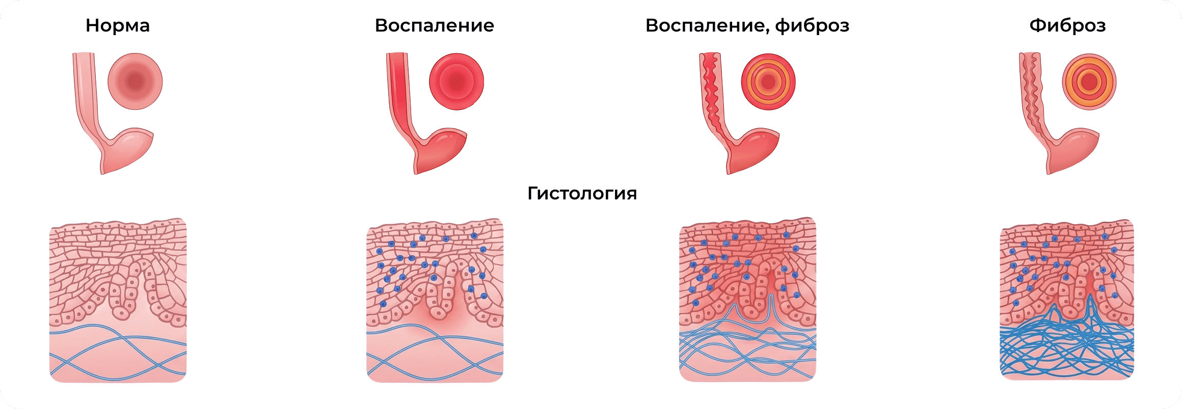 Течение заболевания (ЭоЭ) без лечения