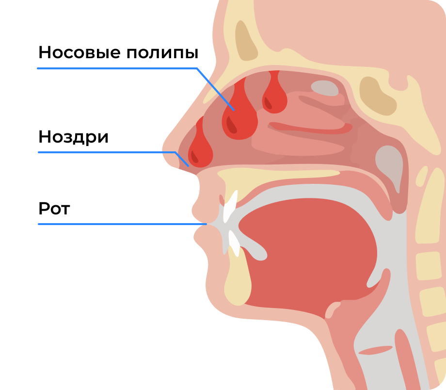 Нос с ХПРС